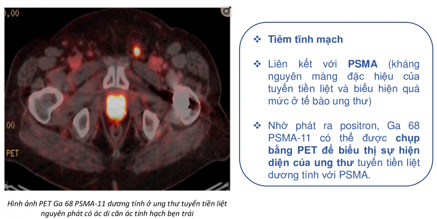 PET-PSMA: Bạn đã từng nghe về PET-PSMA chưa? Đây là một phương pháp chụp ảnh bằng cách sử dụng tế bào gốc để khám phá ung thư đường tiết tuyến tiền liệt. Hãy xem hình ảnh liên quan để biết thêm về phương pháp này nhé!