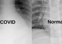 Không cần PCR: Phát triển Phương pháp mới sử chụp ảnh X-quang chẩn đoán COVID-19