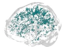 MRI phát hiện bất thường trong não hậu COVID