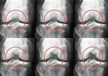 Hình ảnh X-quang và AI cải thiện phân loại viêm xương khớp