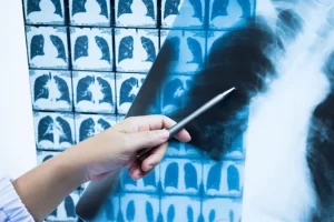 CT phát hiện bất thường ở phổi tồn tại hai năm sau COVID-19
