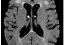 MRI: vai trò trong nghiên cứu lão hóa của bộ não